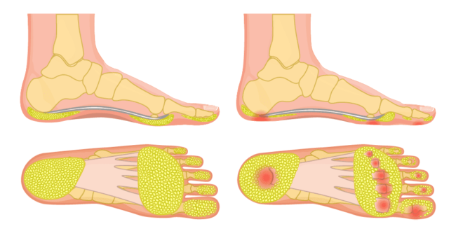 Diabetic-foot-pressure Diabetic-foot-pressure