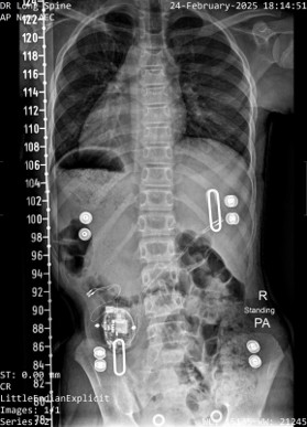 scoliosis xray after