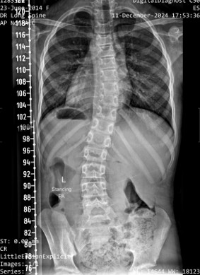 scoliosis xray before